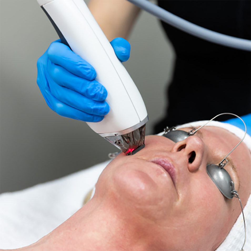 MOXI Laser: A Gentle Approach to Skin Renewal