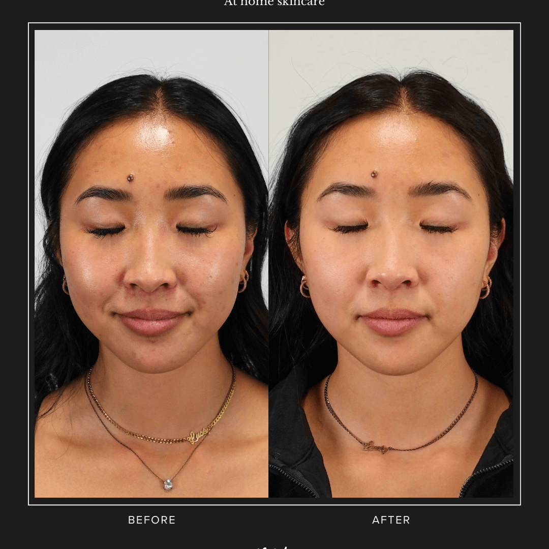 Before and after results using Radiance+ Resurfacing Serum from MK Aesthetics, showcasing clearer skin.