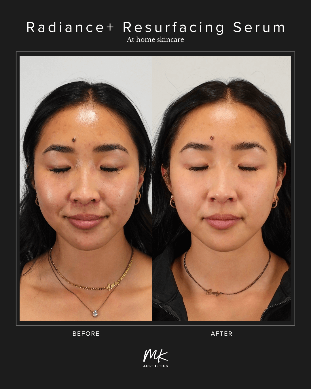 Before and after results using Radiance+ Resurfacing Serum from MK Aesthetics, showcasing clearer skin.
