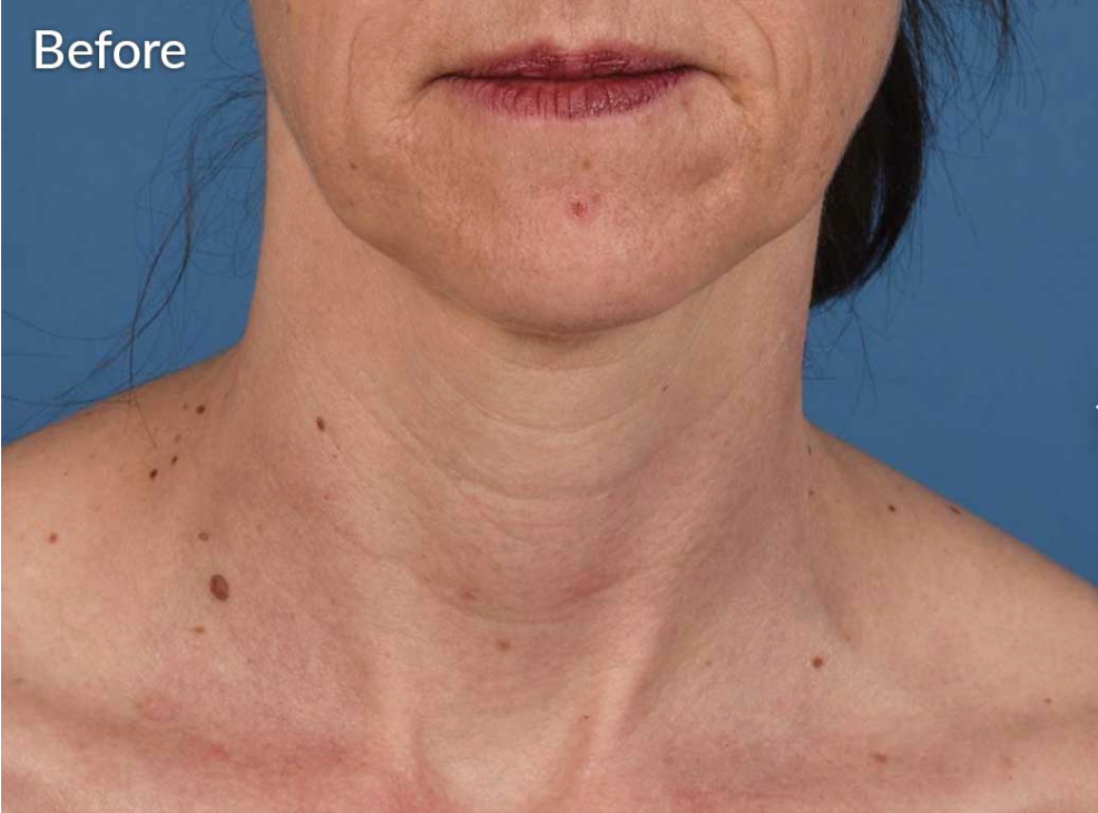 Before image showcasing skin condition at MK Aesthetics Med Spa in Minnetonka, highlighting areas for potential treatment.