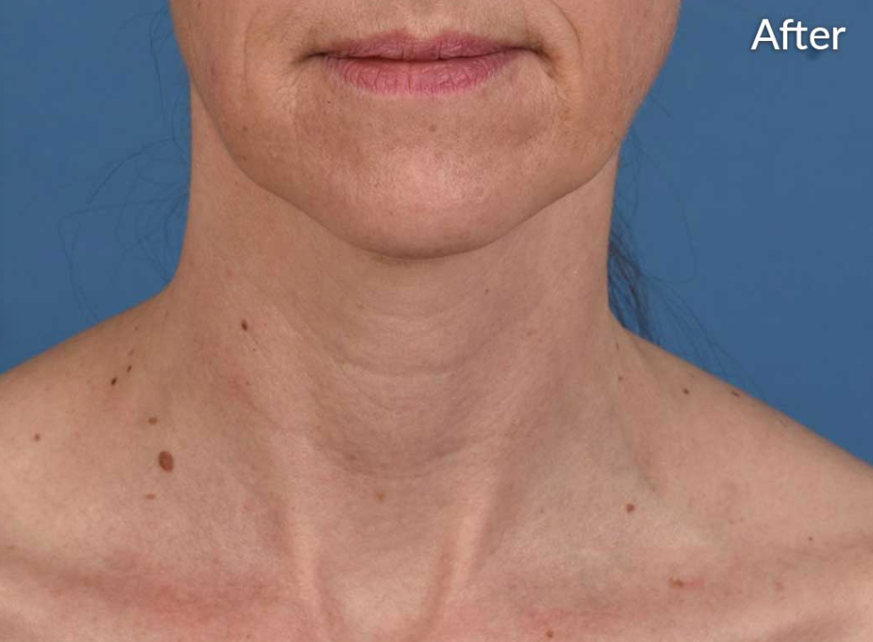 After treatment at MK Aesthetics Minnetonka showing improved skin texture and tone on neck area.