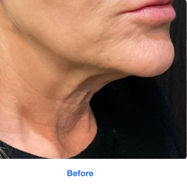 Before treatment at MK Aesthetics Minnetonka, showcasing a side profile with visible skin texture.