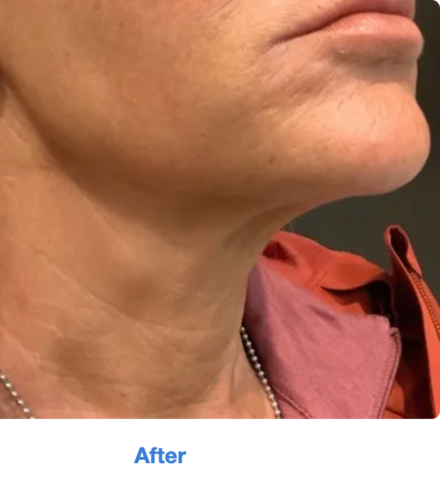 Before and after image showcasing treatment results at MK Aesthetics Minnetonka Med Spa, highlighting rejuvenated skin.
