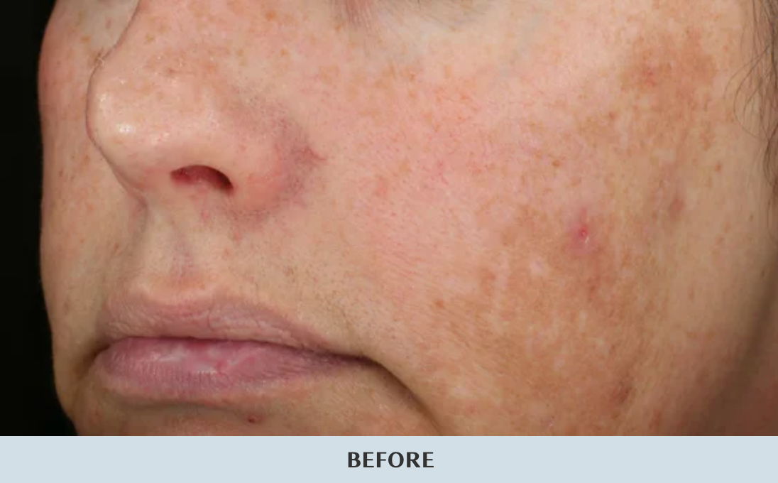 Before skin treatment at MK Aesthetics Minnetonka, highlighting skin texture and imperfections.