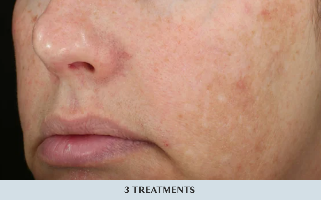Before and after image showcasing skin improvement from 3 treatments at MK Aesthetics Med Spa in Minnetonka.
