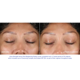 Before and after image showing results of Extra Strength Active Peel Brightening System treatment on facial skin.