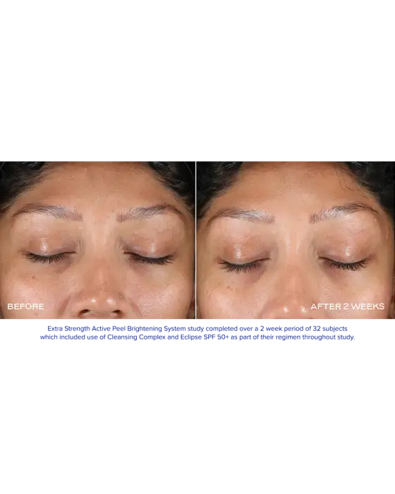Before and after image showing results of Extra Strength Active Peel Brightening System treatment on facial skin.