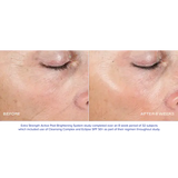 Before and after results using Extra Strength Active Peel Brightening System for improved skin appearance.