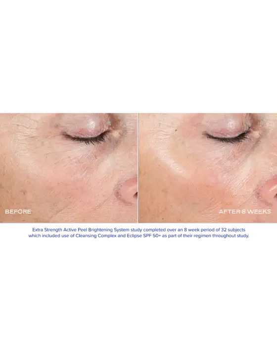 Before and after results using Extra Strength Active Peel Brightening System for improved skin appearance.