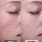 Before and after results of Radiance+ Resurfacing Serum on skin after one week.