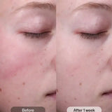 Before and after results of Radiance+ Resurfacing Serum on skin after one week.