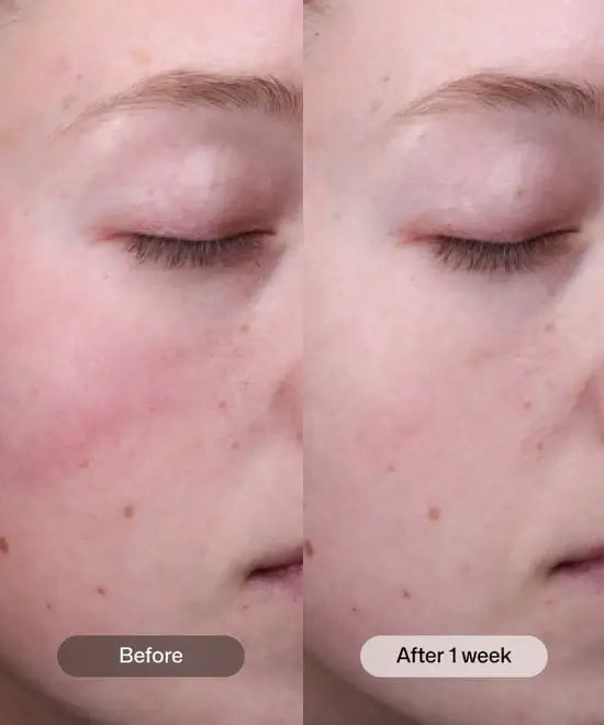 Before and after results of Radiance+ Resurfacing Serum on skin after one week.